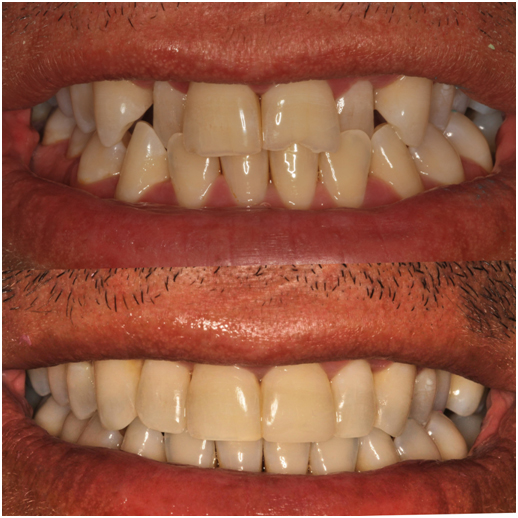 Before and After