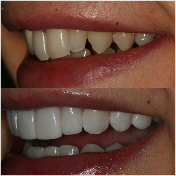 Composite Bonding