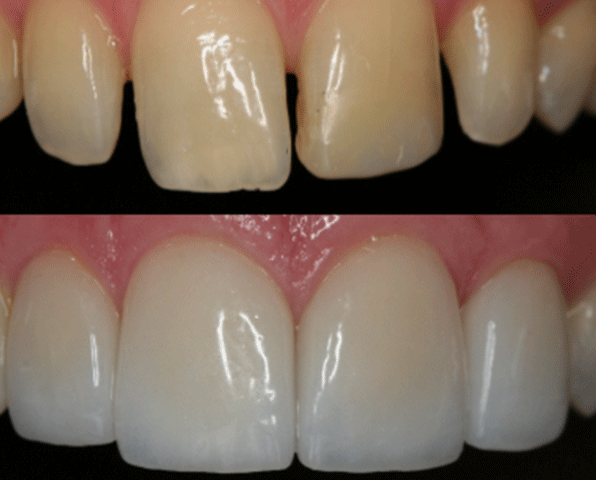 Minimally invasive cosmetic dentistry by Dr Ilan Preiss