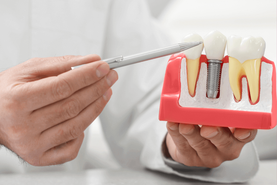 dental implants