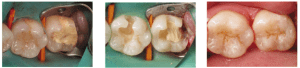 saving your natural teeth - how to avoid root canal