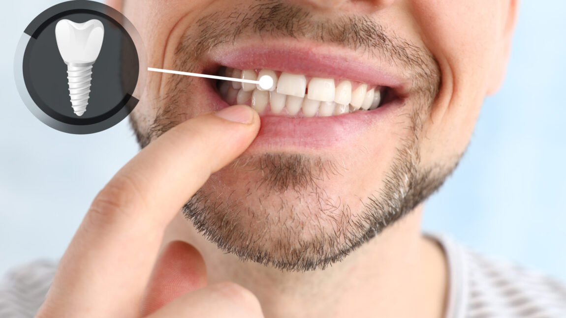 zirconia dental implants