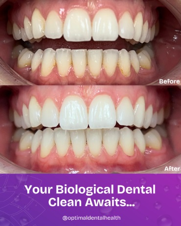 dental-clean-awaits