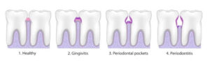 how do gums recede diagram