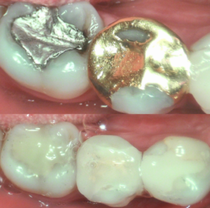 an image showcasing metal fillings being replaced with ceramic inlay and onlays
